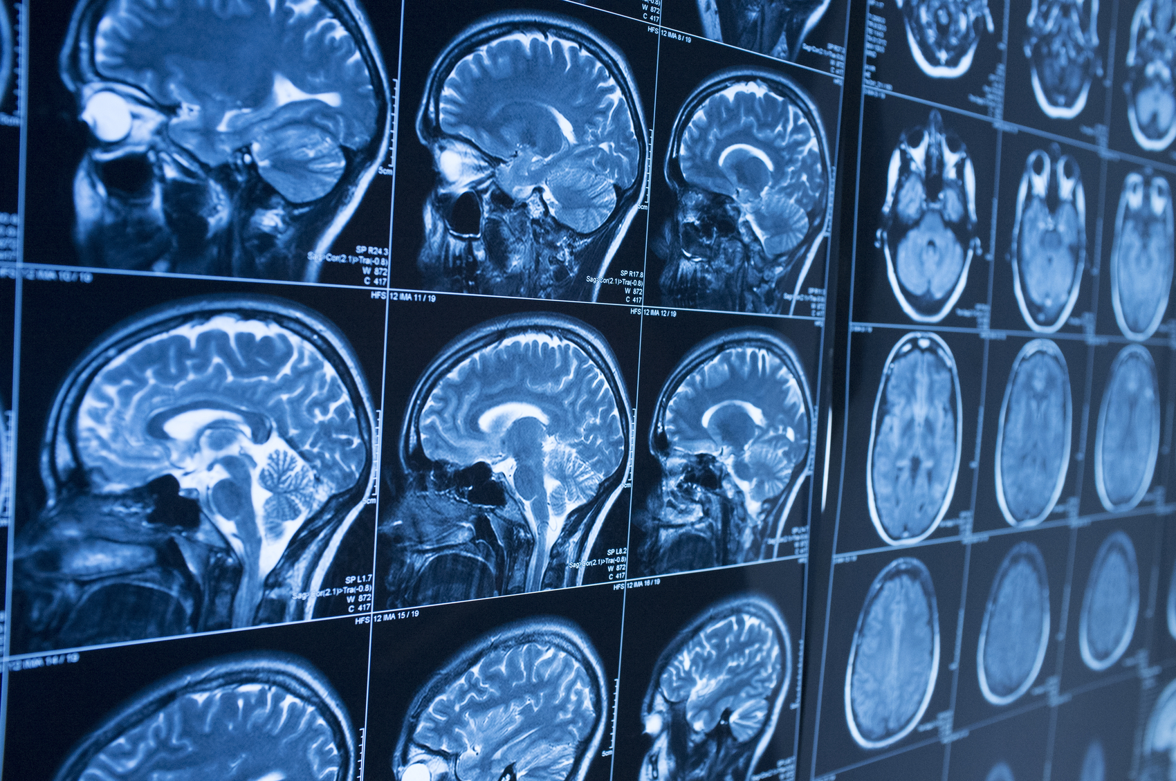The Subtle Signs of Traumatic Brain Injury